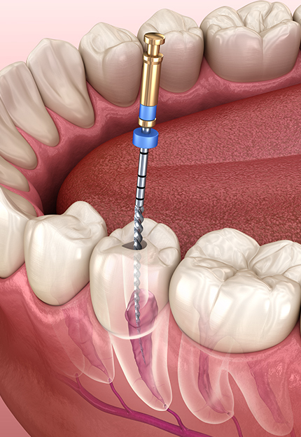 자연치아 살리기
